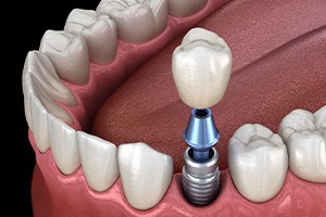 Illustration of single dental implant