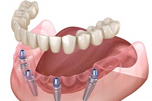 Illustration of implant dentures