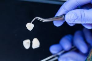 Close up of dentist using precision tool to handle dental veneers